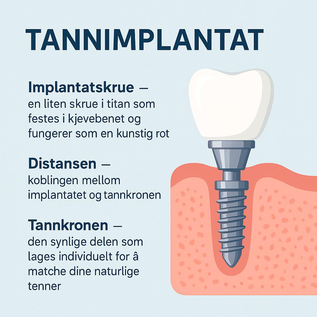 Illustrasjon av tannimplantat med forklaring på implantatskrue, distanse og tannkrone.